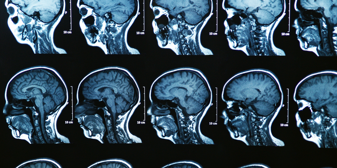 What You Need to Know About Bruce Willis' Devastating Dementia Diagnosis