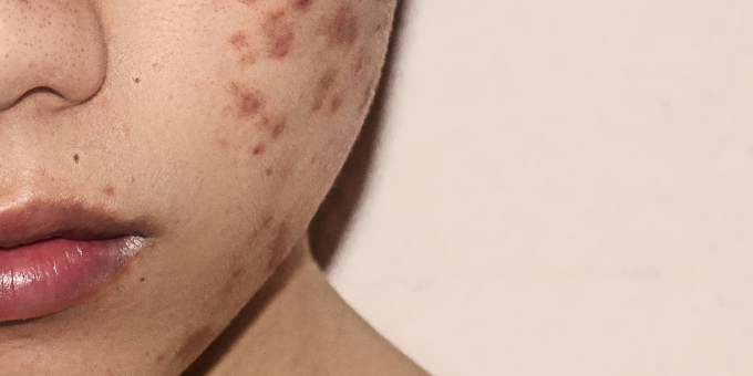 Pimple Problems? How Sugar is Making Your Acne Worse