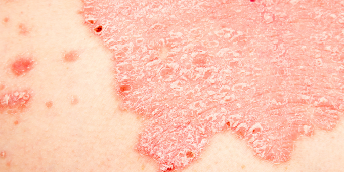 Severe Psoriasis Linked to Low Vitamin D Levels