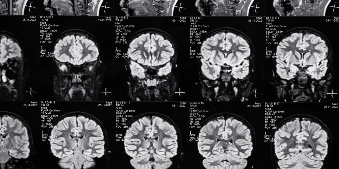 5 Hazardous Habits That Are Shrinking Your Brain