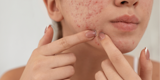 Psoriasis, Eczema, and Acne: The One Thing They Have in Common