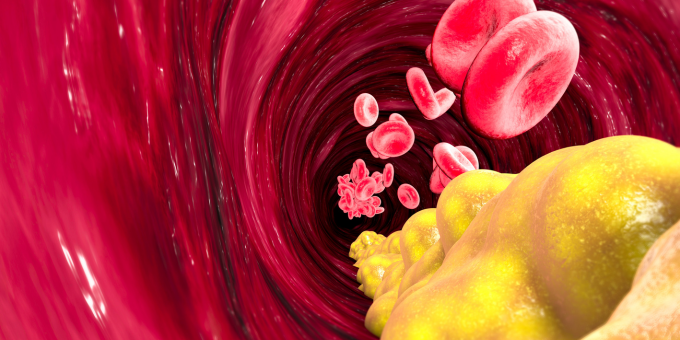 Alarming Research Proves High Cholesterol Drives Liver Disease