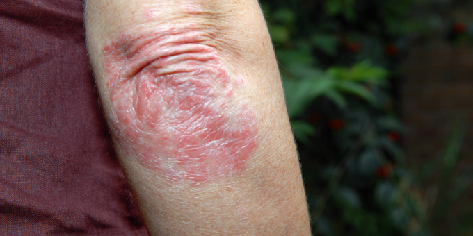Scratching Beneath the Surface: Could Your Psoriasis Be a Sign of Something More Sinister?