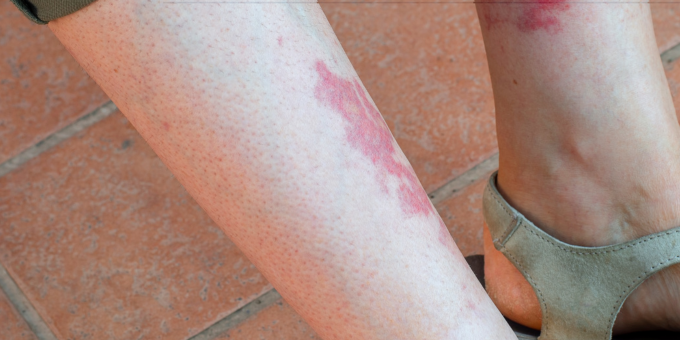 Vasculitis Unveiled: The Signs + Symptoms of the Disease Affecting Ashton Kutcher