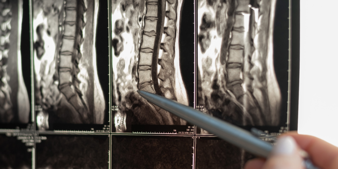 3 Ways to Reduce Your Risk for Degenerative Disk Disease