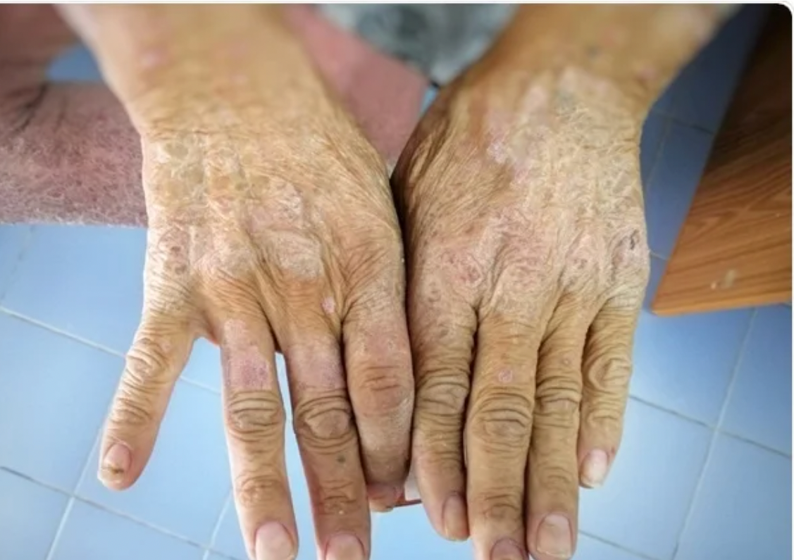 Unveiling Scleroderma: Recognising the Signs and Symptoms